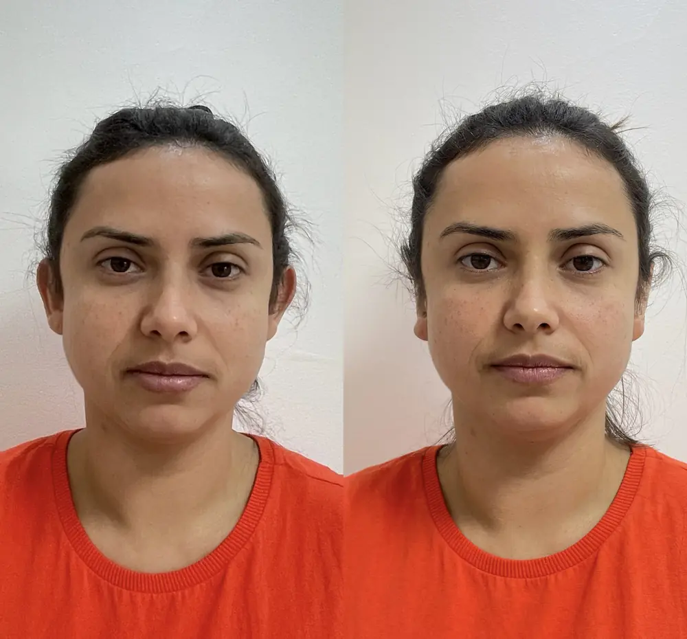 Resultado de Otomodelação no Centro Estético Ana Duarte: antes e depois da correção de orelhas de abano sem cirurgia — paciente 4